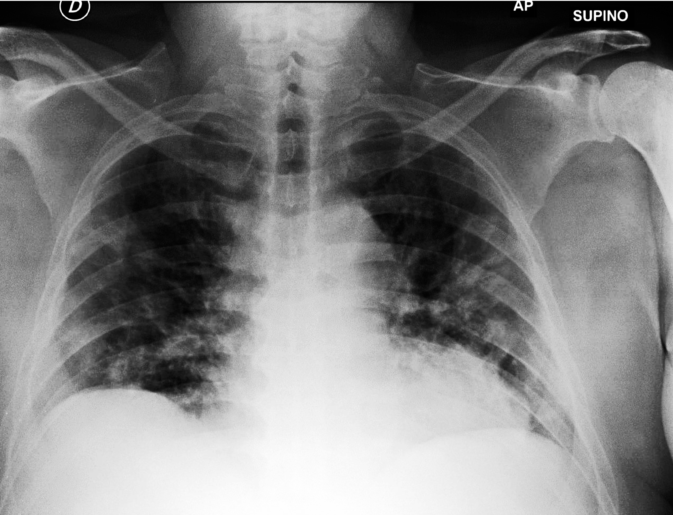 Prediction source X-ray